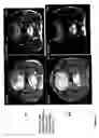 Fig. 10 - Therapy of malignant neoplasias
