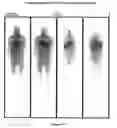 Fig. 16 - Therapy of malignant neoplasias