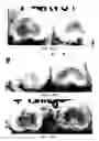 Fig. 23 - Implantable devices for chemonucleolysis of intervertebral discs