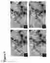 Fig. 10 - Treatment solution and method for preventing posterior capsular opacification by selectively inducing detachment and/or death of lens epithelial cells