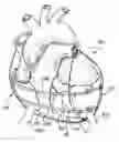 Fig. 01 - Implantable direct cardiac compression device and system