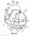 Fig. 08 - Implantable direct cardiac compression device and system