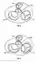 Fig. 04 - Method and apparatus for external stabilization of the heart