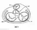 Fig. 05 - Method and apparatus for external stabilization of the heart