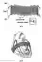 Fig. 06 - Method and apparatus for external stabilization of the heart