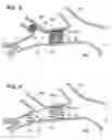 Fig. 03 - Devices for fixing a sensor in a lumen