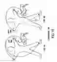 Fig. 06 - Differentiating ischemic from non-ischemic T-wave inversion