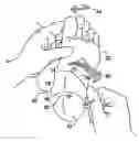 Fig. 01 - Anti-pronation device