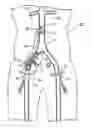 Fig. 01 - Bypass grafting system and apparatus