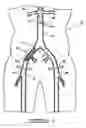 Fig. 04 - Bypass grafting system and apparatus