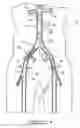 Fig. 05 - Bypass grafting system and apparatus