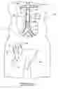 Fig. 07 - Bypass grafting system and apparatus