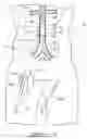 Fig. 09 - Bypass grafting system and apparatus