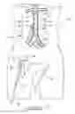 Fig. 14 - Bypass grafting system and apparatus