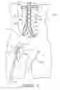 Fig. 16 - Bypass grafting system and apparatus