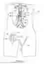 Fig. 18 - Bypass grafting system and apparatus