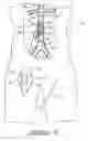 Fig. 19 - Bypass grafting system and apparatus