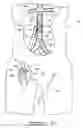 Fig. 26 - Bypass grafting system and apparatus