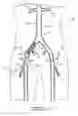 Fig. 30 - Bypass grafting system and apparatus