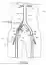 Fig. 31 - Bypass grafting system and apparatus