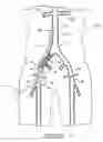 Fig. 32 - Bypass grafting system and apparatus