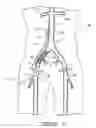 Fig. 33 - Bypass grafting system and apparatus