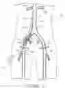 Fig. 34 - Bypass grafting system and apparatus