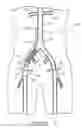 Fig. 35 - Bypass grafting system and apparatus