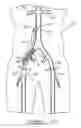 Fig. 36 - Bypass grafting system and apparatus