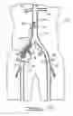 Fig. 37 - Bypass grafting system and apparatus