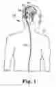 Fig. 02 - Implantable cerebrospinal fluid flow device and method of controlling flow of cerebrospinal fluid