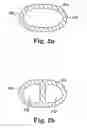 Fig. 03 - Implantable cerebrospinal fluid flow device and method of controlling flow of cerebrospinal fluid