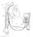 Fig. 01 - METHOD AND APPARATUS FOR ULTRAFILTRATION UTILIZING A PERIPHERAL ACCESS DUAL LUMEN VENOUS CANNULA