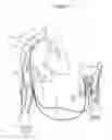 Fig. 03 - METHOD AND APPARATUS FOR ULTRAFILTRATION UTILIZING A PERIPHERAL ACCESS DUAL LUMEN VENOUS CANNULA