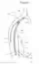 Fig. 04 - METHOD AND APPARATUS FOR ULTRAFILTRATION UTILIZING A PERIPHERAL ACCESS DUAL LUMEN VENOUS CANNULA
