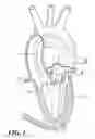Fig. 02 - Endovascular tissue removal device