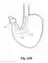 Fig. 41 - Systems and techniques for minimally invasive gastrointestinal procedures