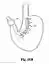 Fig. 43 - Systems and techniques for minimally invasive gastrointestinal procedures