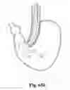Fig. 44 - Systems and techniques for minimally invasive gastrointestinal procedures