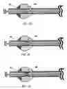 Fig. 03 - Catheter mounted automatic vessel occlusion and fluid dispersion devices