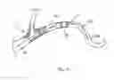 Fig. 20 - Embolic protection system
