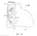 Fig. 03 - Clip-based systems and methods for treating septal defects