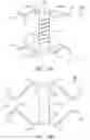 Fig. 30 - Clip-based systems and methods for treating septal defects