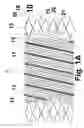 Fig. 02 - Helical stent