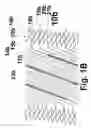 Fig. 03 - Helical stent