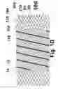 Fig. 05 - Helical stent