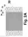 Fig. 07 - Helical stent