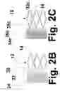 Fig. 08 - Helical stent