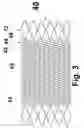 Fig. 09 - Helical stent