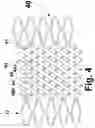 Fig. 10 - Helical stent